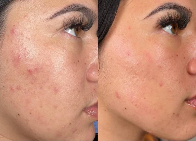 What Is the Best Facial for Acne? Why Hydrafacial Sets the Gold Standard for Clear, Radiant Skin